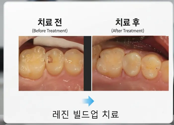 깊은 충치를 신경치료하지 않고 레진 빌드업으로 치료한 증례