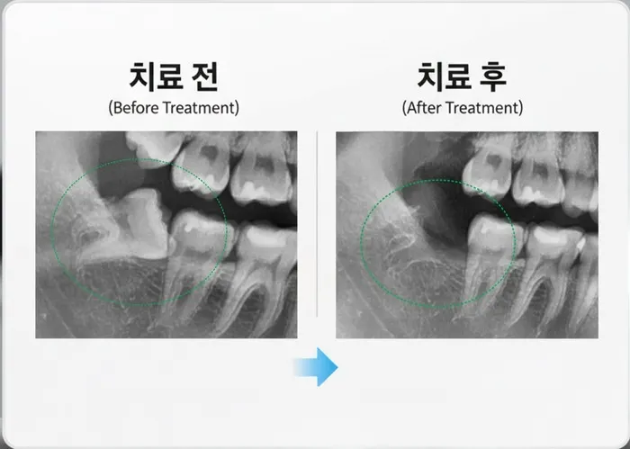 덕풍동치과 옆으로 누운 사랑니 발치 증례