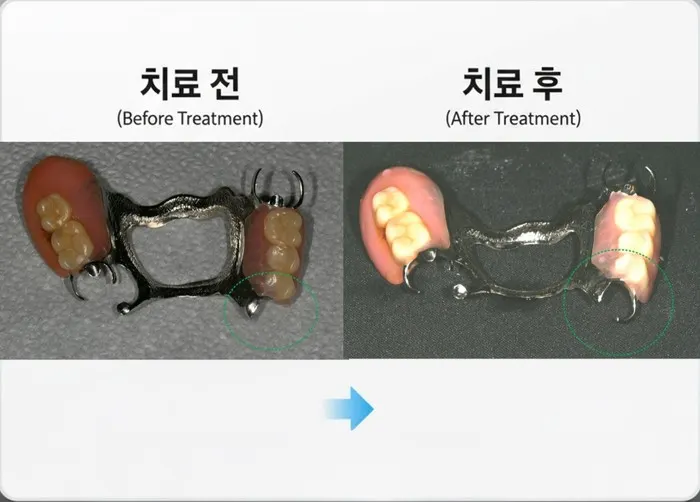 하남치과 부분틀니에서 고리부러진 것 수리한 증례
